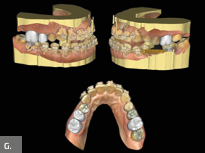Protocolo de aumento da altura facial anterior inferior
